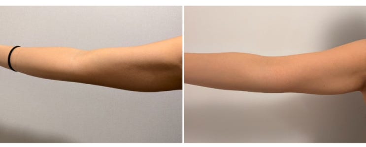  명동다이어트병원 팔뚝다이어트 2회차 지방분해주사 효과 전후 솔직후기