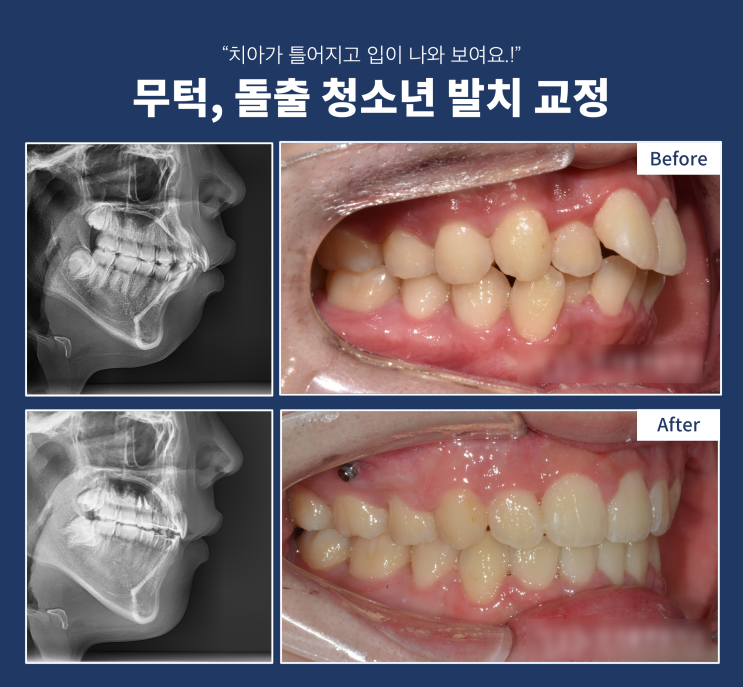 하남 무턱 돌출 교정은 어떻게 할까? 무턱교정 방법, 턱 교정, 발치교정 하남 무턱 돌출 교정은 어떻게 할까? 무턱교정 방법, 턱 교정, 발치교정