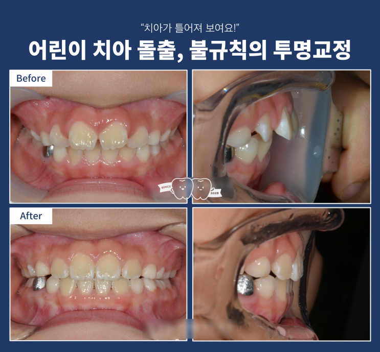 어린이 투명교정(인비절라인)으로 치아 돌출과 불규칙 개선 효과, 인비절라인 글로벌 갤러리 어린이 투명교정(인비절라인)으로 치아 돌출과 불규칙 개선 효과, 인비절라인 글로벌 갤러리
