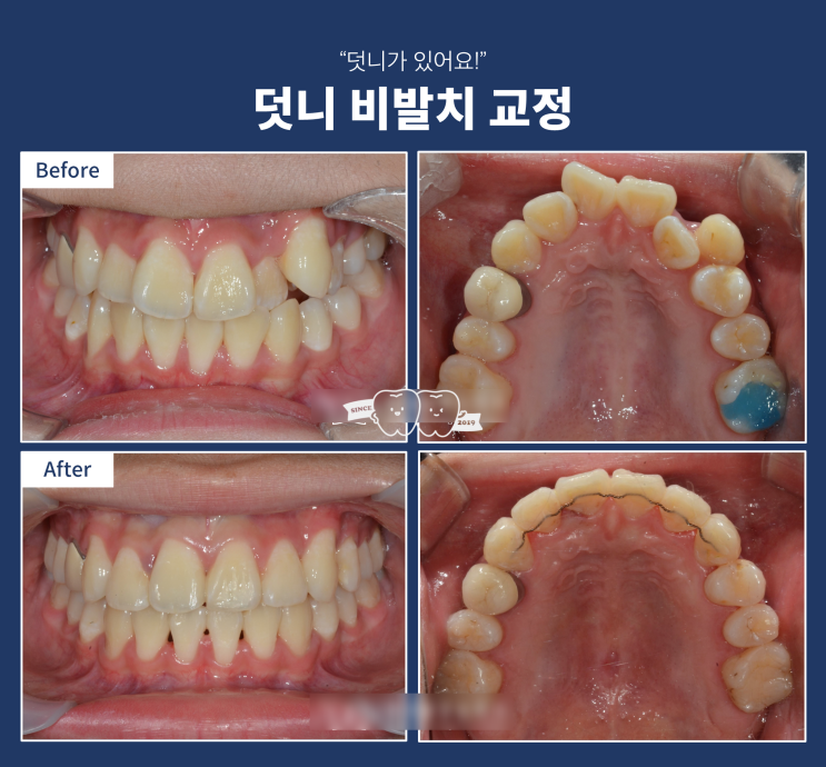 덧니 교정, 발치하지 않고 교정하고 싶어요! 하남 미사 교정 치과 덧니 교정, 발치하지 않고 교정하고 싶어요! 하남 미사 교정 치과