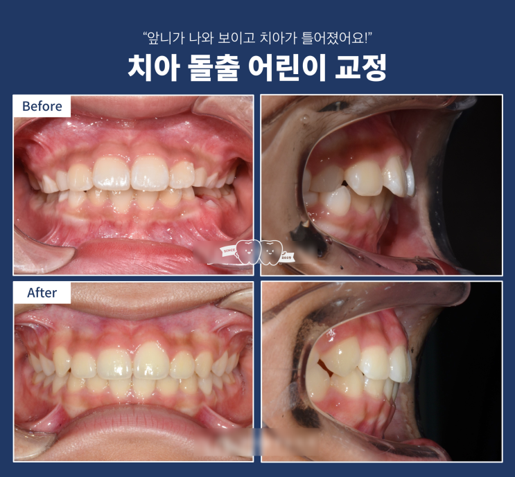 어린이 부정교합에서 프리올소의 효과 및 중요성, 하남 어린이 교정의 역할 어린이 부정교합에서 프리올소의 효과 및 중요성, 하남 어린이 교정의 역할