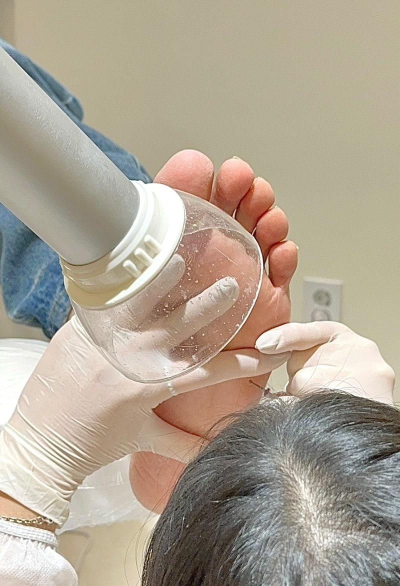 레푸스 종로점에서 티눈제거 후기 및 가격