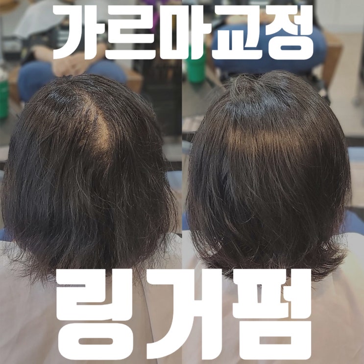  링거펌으로 해결하는 40대 여성 가르마 교정, 수원 아엠헤드 비법 공개