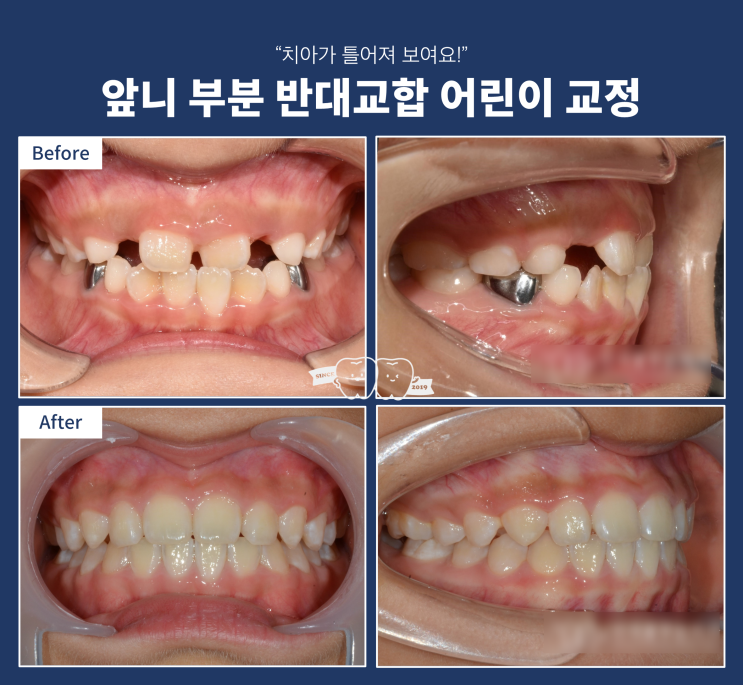 앞니 부분 반대교합 어린이 교정, 가장 효율적인 교정은 어린이 교정! 앞니 부분 반대교합 어린이 교정, 가장 효율적인 교정은 어린이 교정!