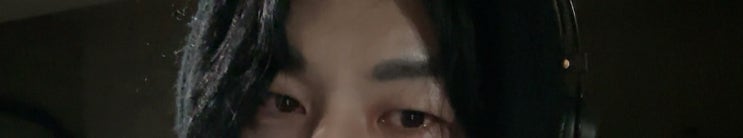  남자 눈매교정 붓기 2일차 내돈내산 후기