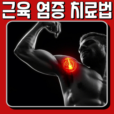 근육 염증, 왜 생길까? 치료와 예방법 총정리!