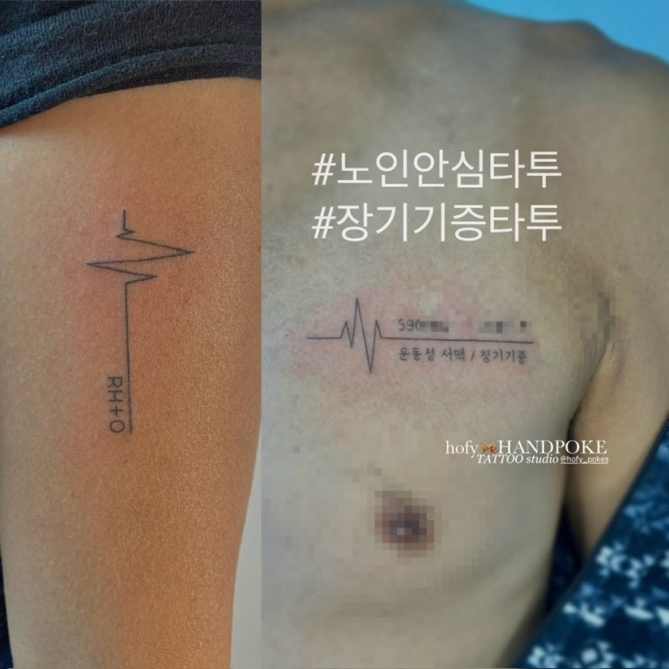  인천 치매안심타투 '노인을 위한 안전하고 적은통증'