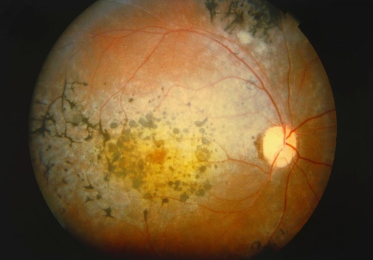  색소성 망막염 Retinitis pigmentosa 이란?!