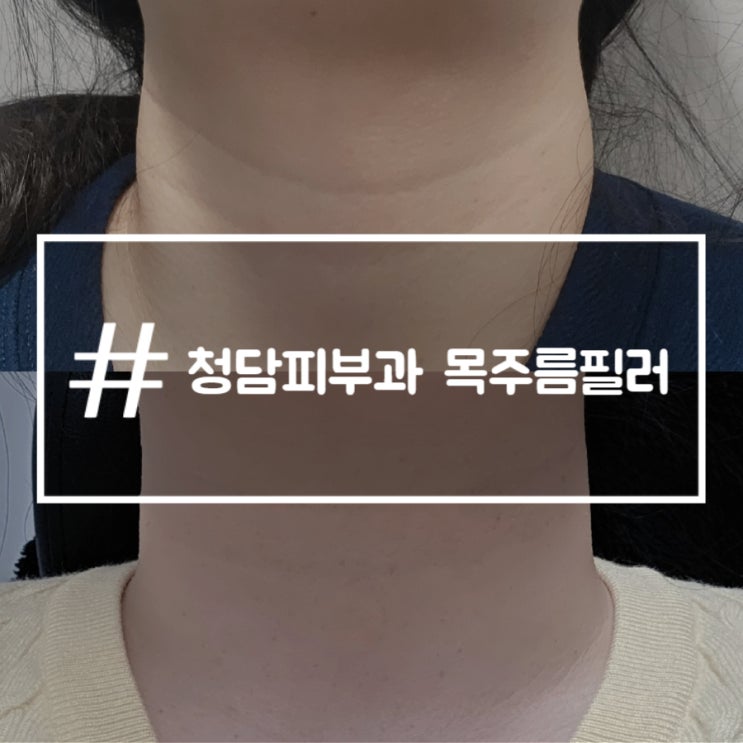 청담피부과 목주름필러 매끄넥 후기 효과 통증 부작용