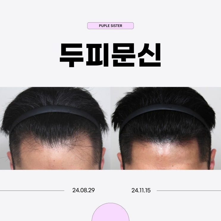  홍대입구역피부과 남성탈모, 두피문신 헤어라인 후기
