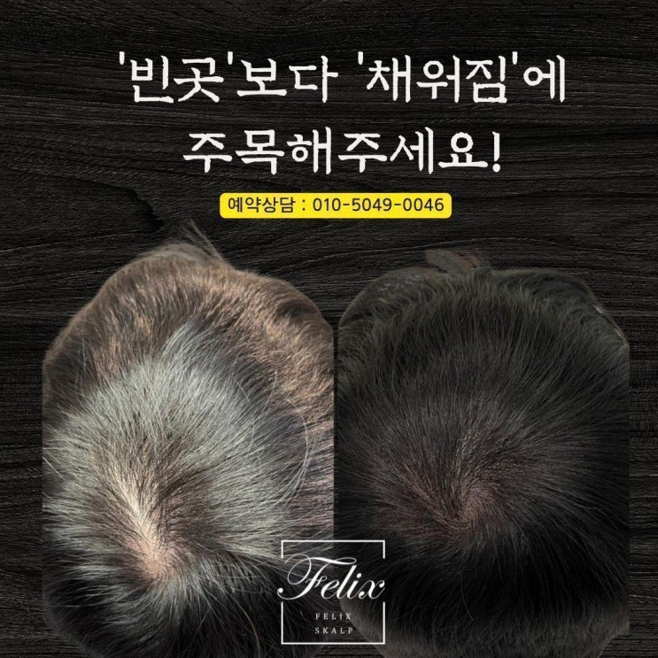  탈모로 인한 스트레스, 김포구래동두피문신과 탈모관리로 극복!