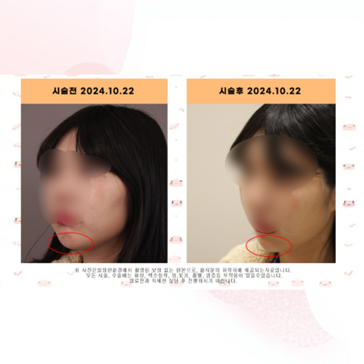  건대 피부과 무턱 턱끝필러 전후 비교, 자연스럽게 채우는 TIP