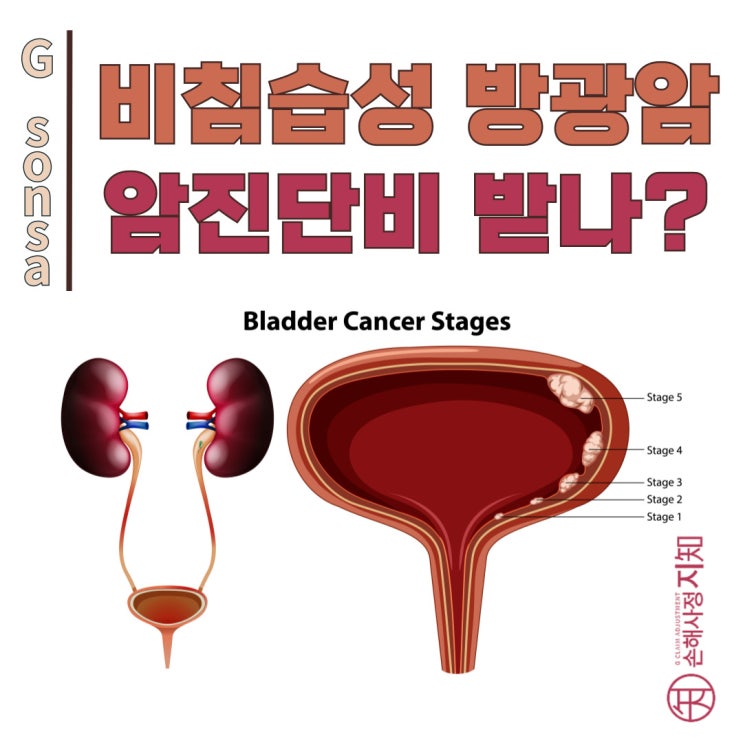  비침습성 방광암도 '암'입니다 - 보험금 전액 받은 실제 사례 - [조정례, BoDa]