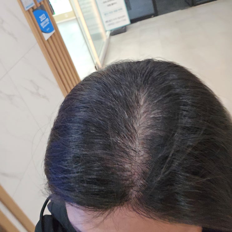  평택 두피관리, 웰킨 평택점 두피가 시원하네