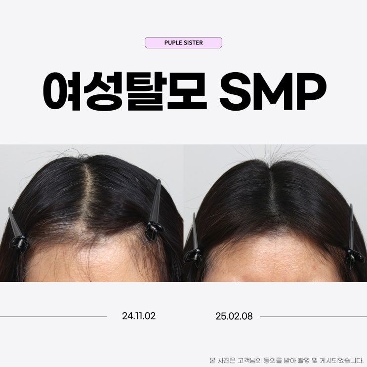 신촌피부과 여성탈모, 스트레스성 머리빠짐 해결법