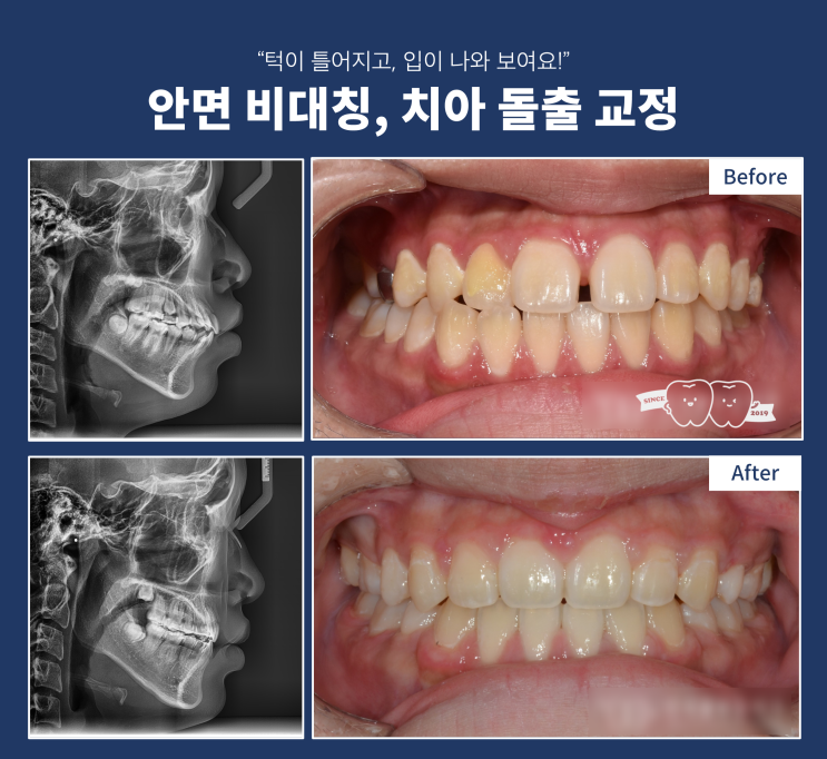안면비대칭과 치아 돌출 교정치료, 입술이 두꺼운 경우 발치 교정 효과는? 안면비대칭과 치아 돌출 교정치료, 입술이 두꺼운 경우 발치 교정 효과는?