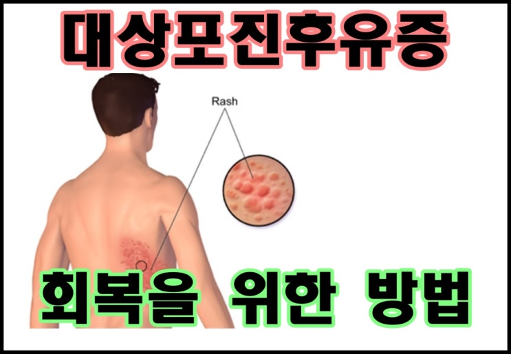  대상포진후유증 회복을 위한 방법