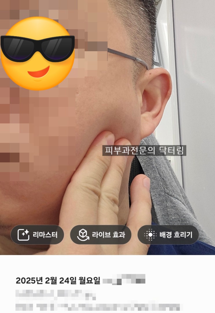  울쎄라 통증, 시술 후 나중에 1주 지나서 아픈 경우도 있다 (시술 시 통증 말고) , 그리고 정품스티커 인증이벤트 종료