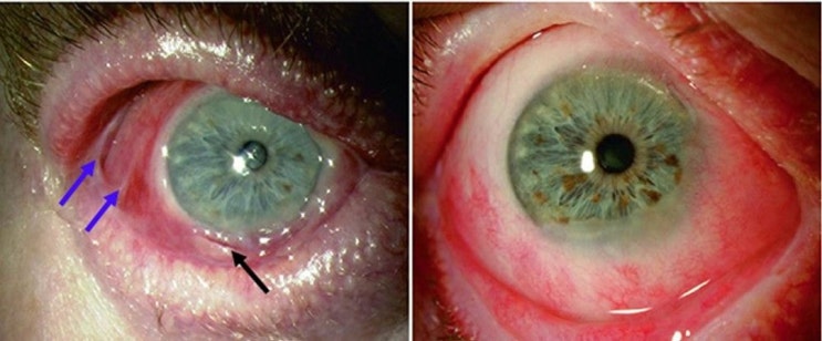 안구 점막 천포창(점막 천포창, 안구 점막 천포창, Cicatricial 천포창; 안구 cicatricial pemphigoid; 양성 점막: 천포창)