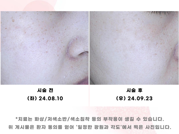  왕십리 피코토닝 전후 후기, 기미 잡티 치료 잘하는 곳은?