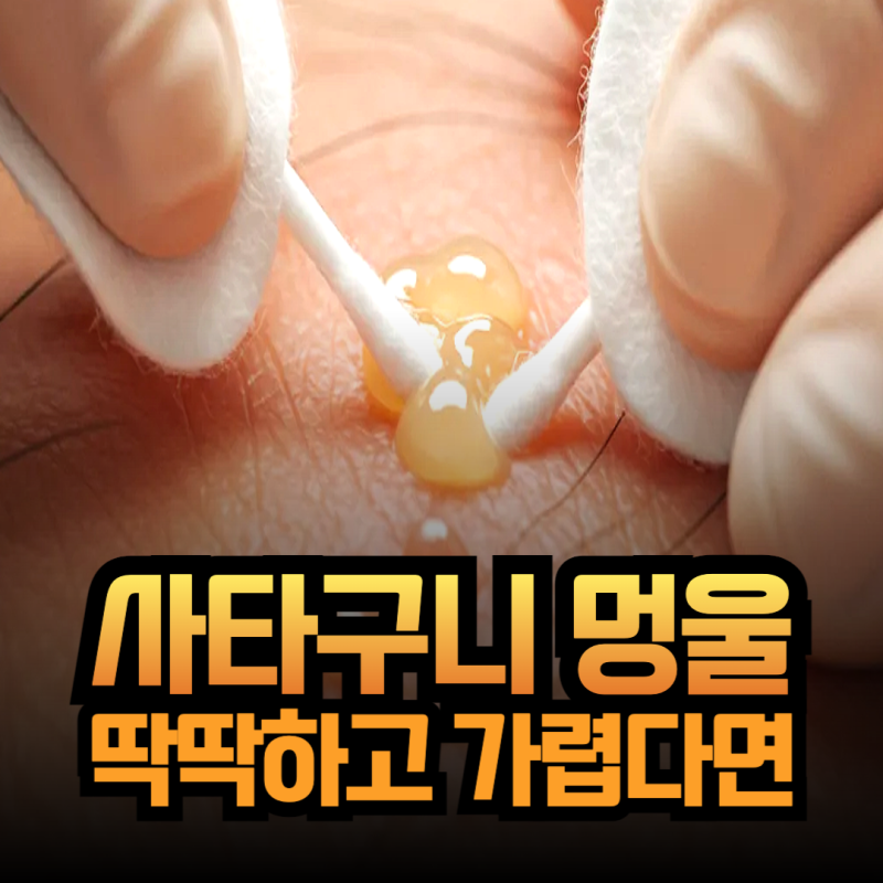 여자 사타구니 멍울 같은 종기, 딱딱하고 가려움 통증!