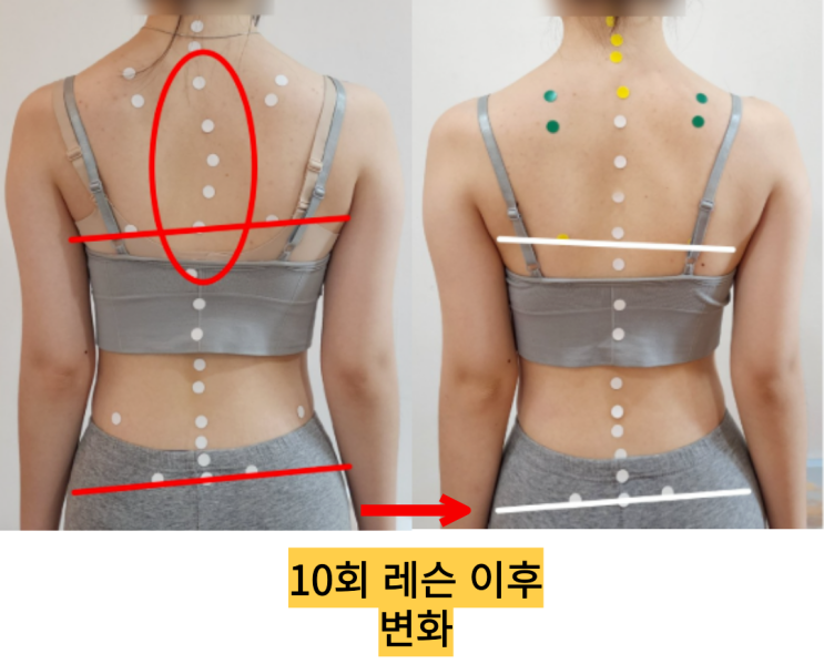  [부산 동래 아동•청소년 척추측만증] 측만 교정에 가장 중요한 '이것'