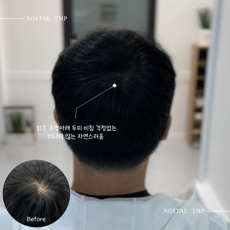 대전정수리탈모, 왜 두피문신이 답일까?
