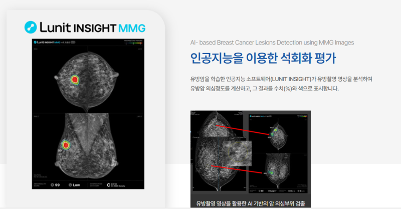 석회화 조직검사 : 조정훈유바외과- 유방암 클리닉