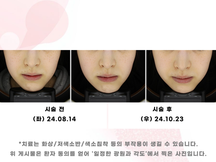  건대피코토닝 레이저 후기, 실제 효과는?