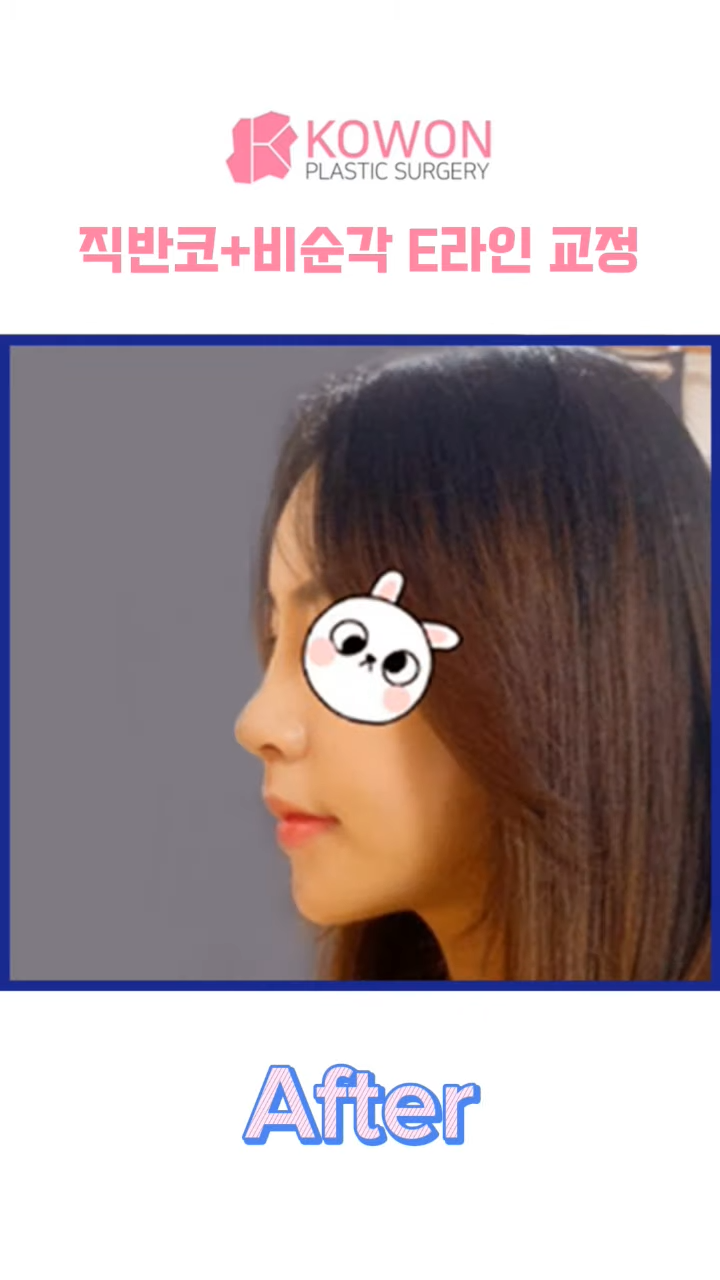 비순각수술하고 코보형물 움직임, 비주붓기 증세가 있어요! 해결 방법은? 사진 8