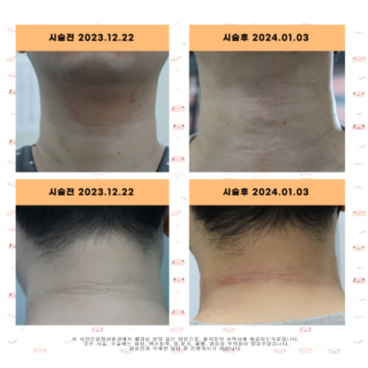  목주름 필러 전후 사진부터 부작용까지 완벽정리