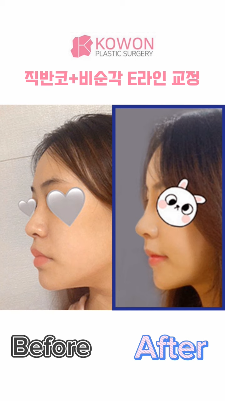 비순각수술하고 코보형물 움직임, 비주붓기 증세가 있어요! 해결 방법은? 사진 9