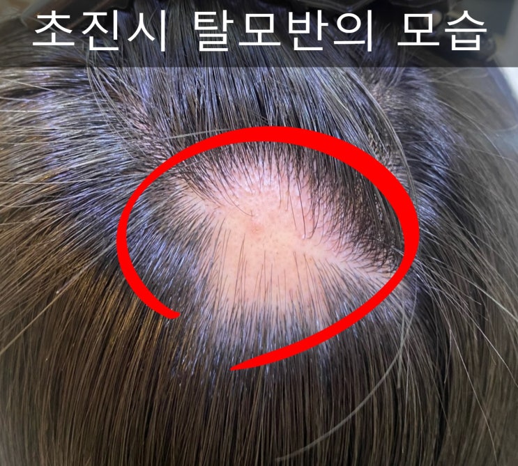  원형탈모에 관해서. 원인과 특징, 치료 기간은?