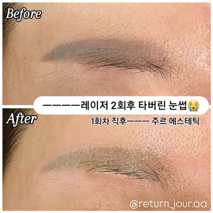  ️레이저 후 타버린 눈썹?️범일동 주르 에스테틱