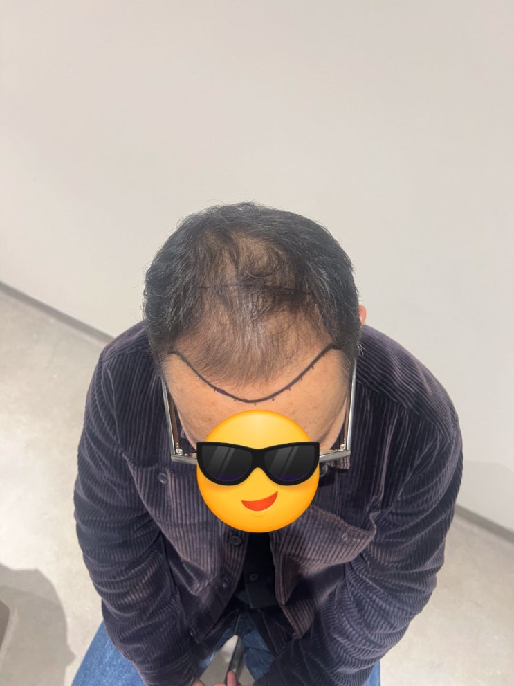  25년 1월 영국에서 터키까지 모발이식 받고 온 후기