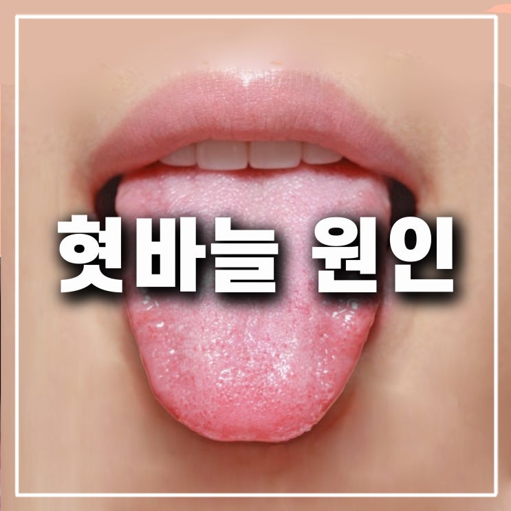 혓바닥 혓바늘 빨리 없애는법 갈라짐 원인 따가움 하얀 돌기 돋을때 알보칠 연고