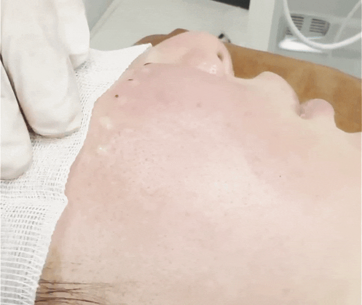  건성 피부 로션 발라도 건조하다면 리쥬란 2cc 효과 충분할까?