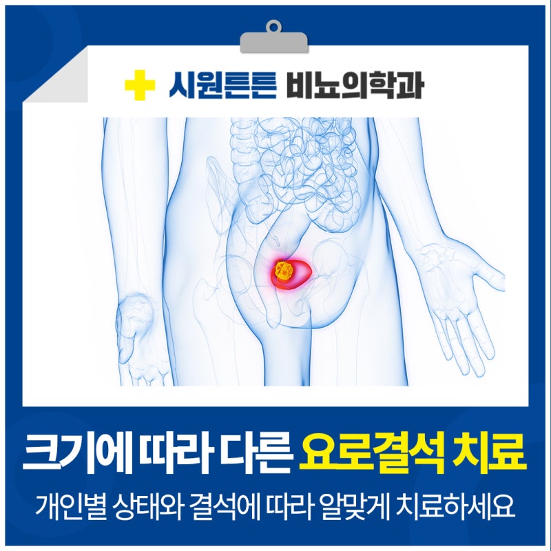 대전 유성구 요로결석 크기에 따라 달라지는 치료법