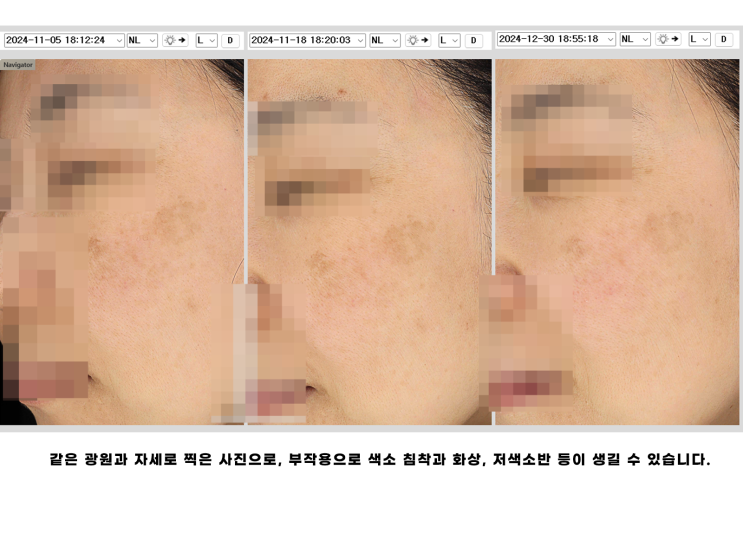  성수피부과 기미잡티 제거 잘하는 곳 선택법 Check