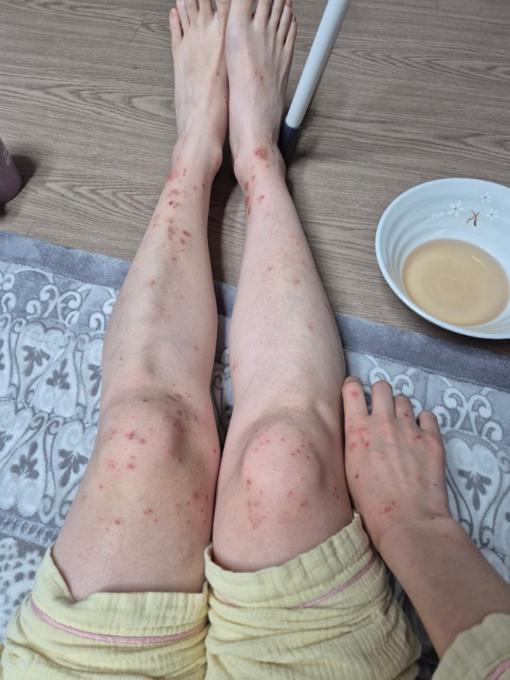  원인불명 두드러기, 간지러움증, 발진 치료기 (진행중)