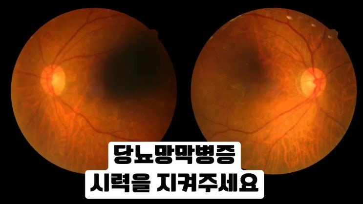  당뇨망막병증 증상 진행 경로 검사 치료 관리법
