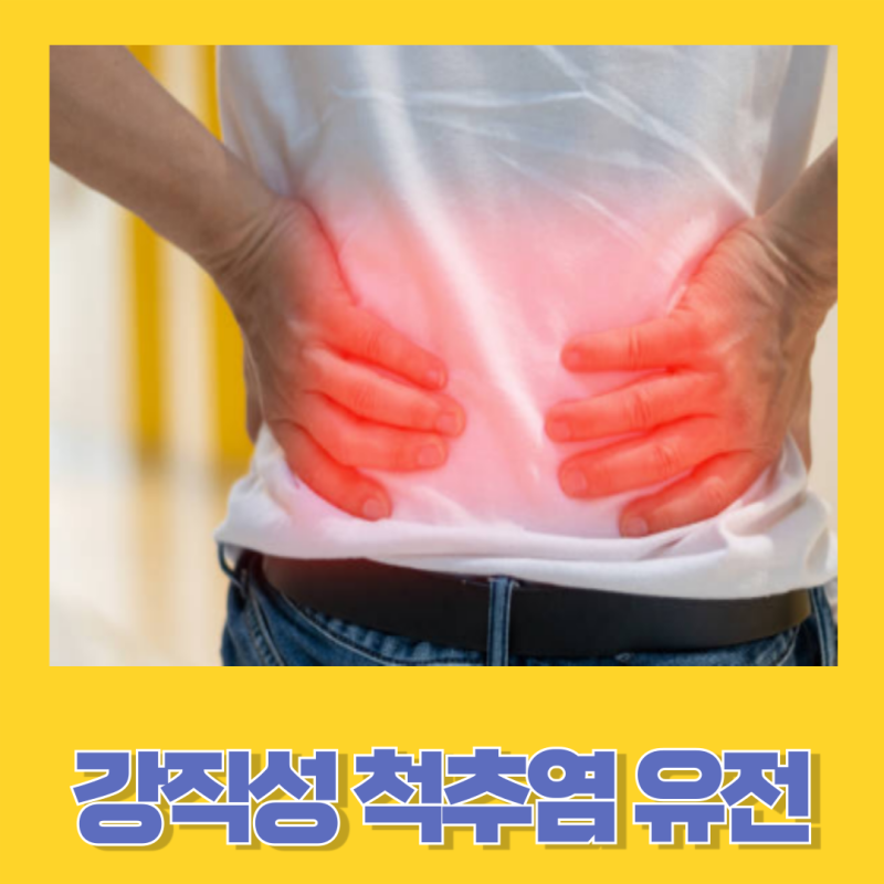 강직성 척추염 원인 유전가능성 주요증상 치료방법