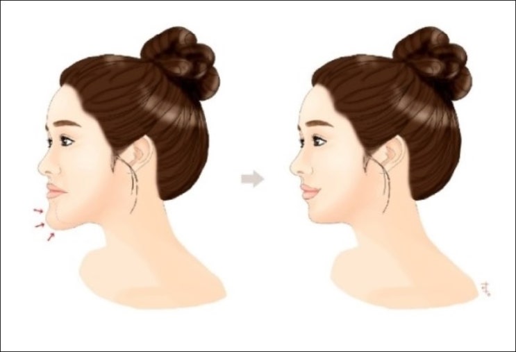  턱끝 보톡스 부작용 효과 총정리