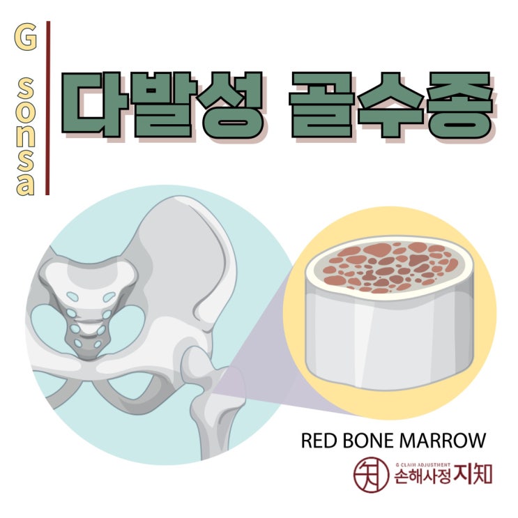  다발성 골수종(Multiple Myeloma) - 뼈에 구멍이 생기는 혈액암, 초기 증상은 무엇일까? - [혈액암, 1부]