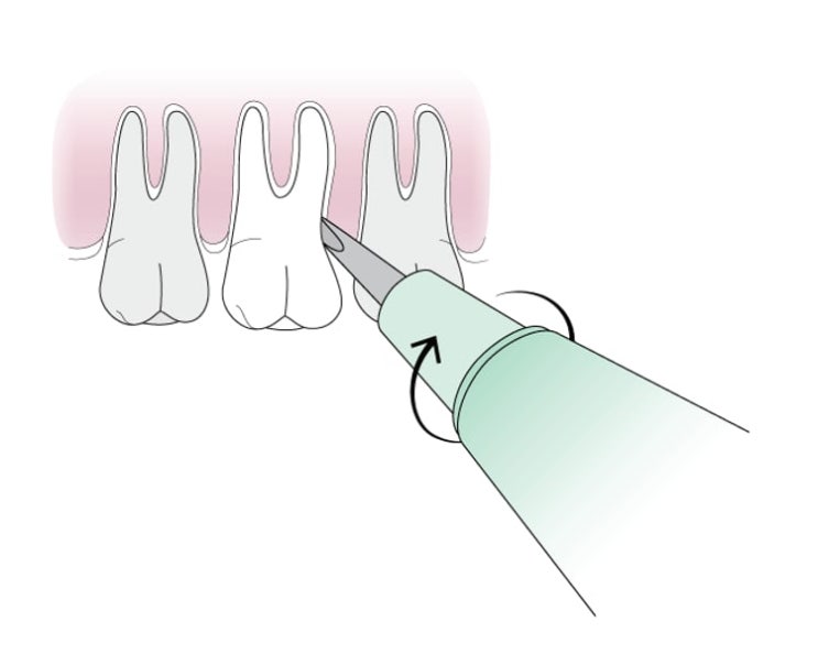 응급 치아 발치를 하는 방법