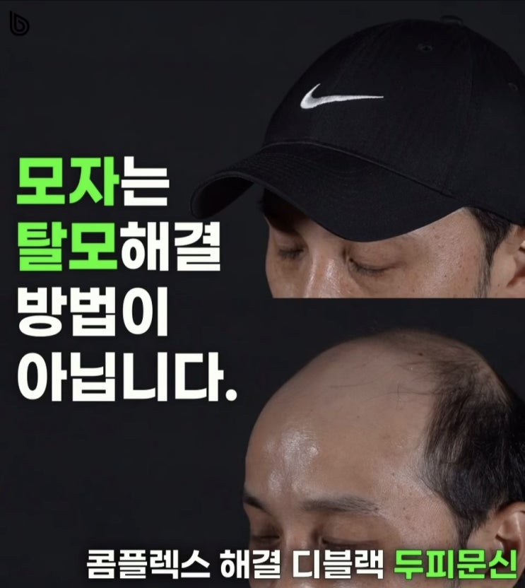  두피문신의 부작용과 위험성 그리고 해결방안