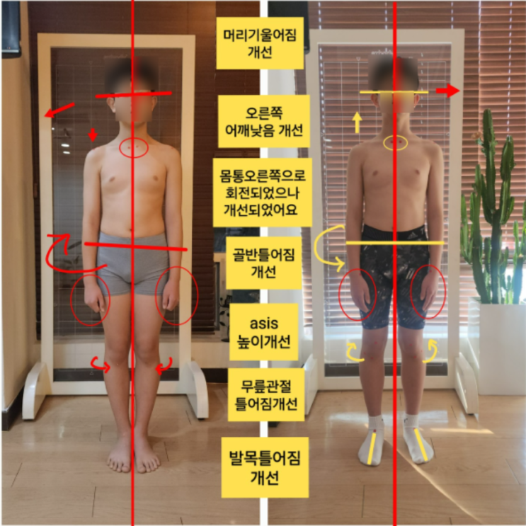  부산 동래 청소년자세교정, 보행과 나쁜자세, 키성장까지