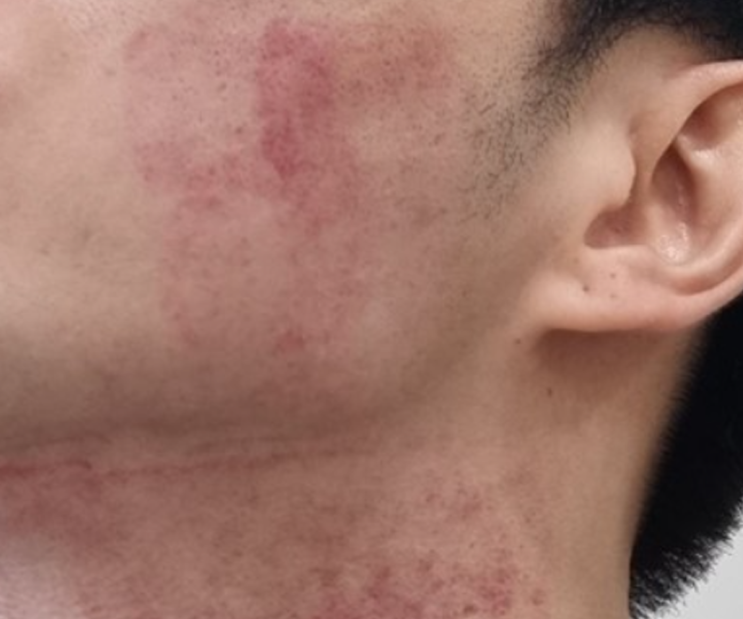  인모드 부작용 볼패임, 붓기, 광대 부각... 예방법은?