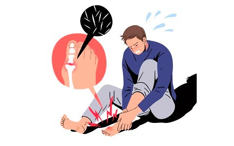  늘어나는 통풍 환자