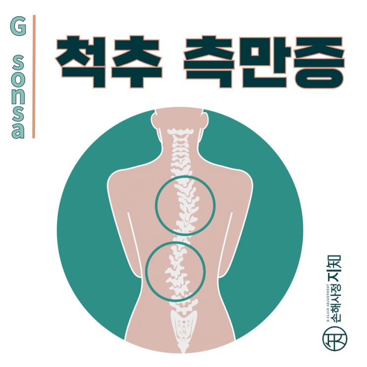 척추측만증 초기 증상, 허리가 휘어지기 전에 잡아라! - [질병정보, Why]